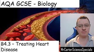 B43  Treating Heart Disease  AQA Biology 91 GCSE [upl. by Earazed]