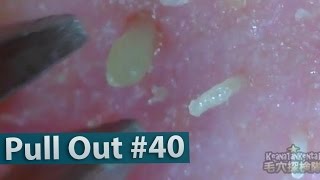 40 Pull Out Blackheads Close up  Blackheads Removal [upl. by Akelam195]