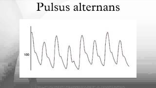 Pulsus alternans [upl. by Zeuqcaj260]