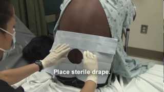 Adult Spinal Tap Procedure Video [upl. by Zurciram]