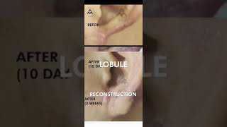 Lobule Reconstruction  shorts youtubeshorts [upl. by Ainex]