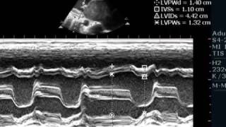 MSRHDGIANT LA WITH SPONTENEOUS ECHOCONTRAST ECHOCARDIO GRAPHY SERIES BY DR ANKUR K CHAUDHARI [upl. by Axela]