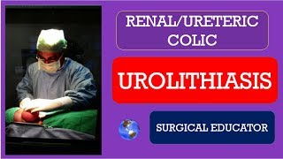 UROLITHIASIS How To DIAGNOSE amp TREAT RENAL URETERIC COLIC [upl. by Akeryt89]