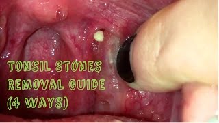 How to Remove Tonsil Stones Tonsillitis at Home [upl. by Alikee330]