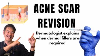 How to treat ACNE SCARS  Dermal Fillers [upl. by Touber522]