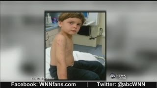 Florida Boy Survives Alligator Attack With Only Scratches [upl. by Nayt]