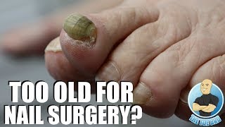 80 YEAR OLD WOMAN WANTS RAMS HORN TOENAIL GONE FOR GOOD [upl. by Nitfa]