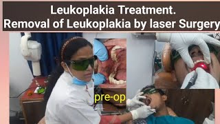 Leukoplakia TreatmentRemoval of Leukoplakia by laser Surgery [upl. by Ihcur]