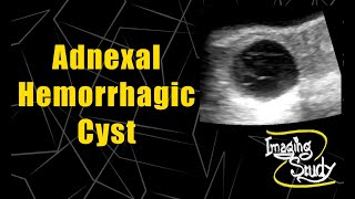 Adnexal Hemorrhagic Cyst  Ultrasound  Case 61 [upl. by Vickie414]