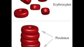 Multiple Myeloma [upl. by Idaline]