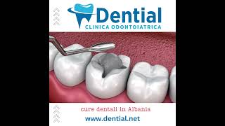 DENTIAL  cure dentali e dentisti in Albania [upl. by Cull627]