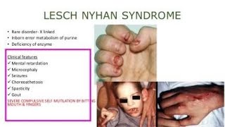 Lesch Nyhan syndrome A defect of Hypoxanthine Guanine phosphoribosyltransferase enzyme [upl. by Turoff]