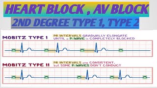 HEART BLOCK AV BLOCK SECOND DEGREE HEART BLOCKMOBITZ 1 2  أنسداد الدفيرة الكهربائية أحصار القلب [upl. by Ruon]