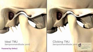 TMJ Clicking  Wellington Village Orthodontics [upl. by Alyse]