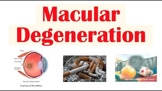 Macular Degeneration  Wet vs Dry  Risk Factors Pathophysiology Symptoms Diagnosis Treatment [upl. by Iaj684]