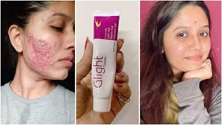 Dermatologist Recommended Best Cream to Remove Pimple Marks Dark spots Pigmentation acne scars [upl. by Scoles]