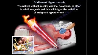 Malignant Hyperthermia  Everything You Need To Know  Dr Nabil Ebraheim [upl. by April]