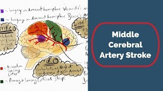 Middle Cerebral Artery Stroke [upl. by Crosby58]