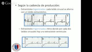 MODULO DE ELECTROCARDIOGRAFIA EXTRASISTOLES Y LATIDOS DE ESCAPES [upl. by Dorlisa]