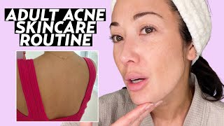 Skincare Routine for Adult Acne amp Rosacea  Susan Yara [upl. by Teresita]