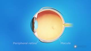 What is retinopathy of prematurity ROP [upl. by Mcnair]