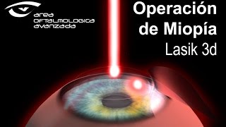 OPERACIÓN de MIOPIA LASER en 3D  Área Oftalmológica Avanzada [upl. by Tobin]