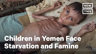 Thousands of Children in Yemen Face Starvation and Famine  NowThis [upl. by Ynnob203]