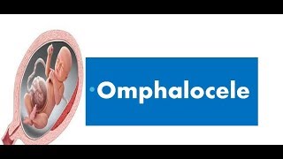 Omphalocele [upl. by Kcirnek]