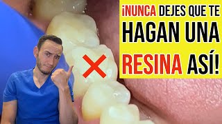 Nunca dejes que te hagan una resina dental así [upl. by Aiuqet]