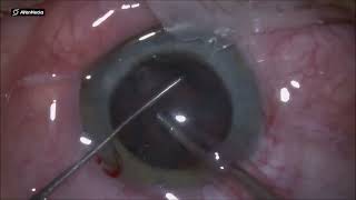 Soft cataract horizontal chop [upl. by Adigirb330]