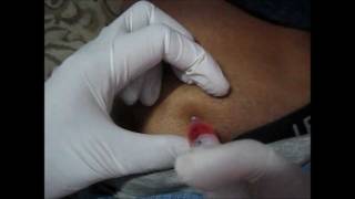 How To Give An IM Injection At Buttocks amp Choose Site For Injection [upl. by Ogilvie]