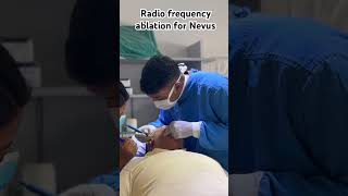 Dermatology Procedure at Dhulikhel Hospital 🏥 doctor dermatology dance music bollywood med [upl. by Llerehs176]