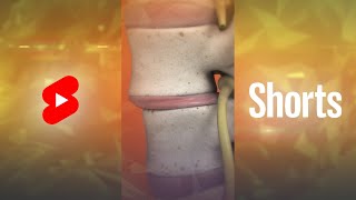 What is Spondylolisthesis  Vertebral Slippage Shorts [upl. by Jensen]