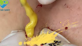 Relaxing Pimple Popping ASMR Soothing Skincare Session [upl. by Tengdin]