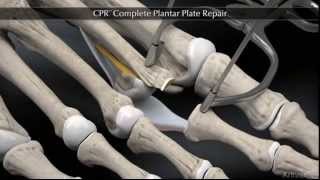 Plantar Plate Repair [upl. by Odraner]