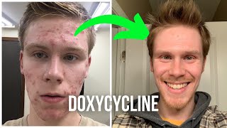 Taking Doxycycline for Acne [upl. by Molini]