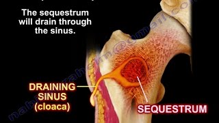 Bone Infection Osteomyelitis Briefly  Everything You Need To Know  Dr Nabil Ebraheim [upl. by Nitsirk]