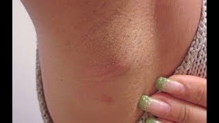 Home Remedies for Hidradenitis Suppurativa [upl. by Rurik]