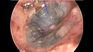 Hemotympanum  Blood inside ear drum   Ear Canal Cleaning [upl. by Nosydam]