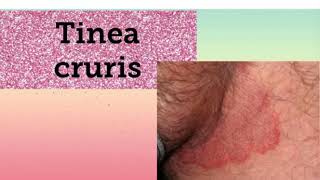 Tinea cruris  fungal infection in Hindi [upl. by Nichy409]