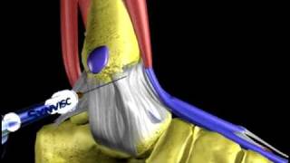 Osteoartrosis de Tobillo Synvisc Simulacion [upl. by Aniwde572]