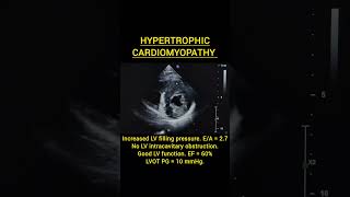 Hypertrophic Cardiomyopathy echocardiomyopathyhypertrophymitralcardiacheartfailurecardiology [upl. by Akemehs]