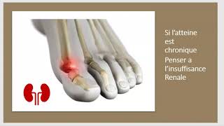 Goutte Acide urique Causes Symptômes Traitement Régime Cristaux Orteil Tophus Colchicine 3 Minutes [upl. by Goetz]