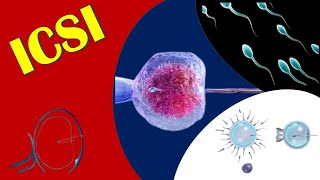 ICSI  Intracytoplasmic Sperm Injection [upl. by Damal439]