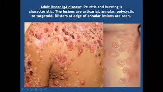 Lecture 49 Bullous Pemphigoid and related diseases PartII Rooks chapter 50 [upl. by Afatsom239]