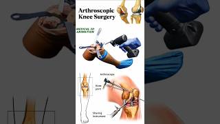 Arthroscopic Knee Surgery medical animation 3d short BiologywithAliya [upl. by Nana451]