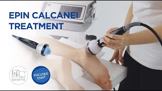 Focused Shockwave Therapy  Epin Calcanei [upl. by Lyda]