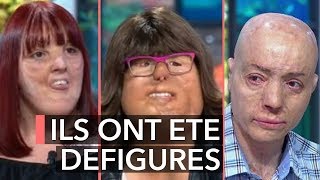 Ils ont été défigurés  Ça commence aujourd’hui [upl. by Kalbli]