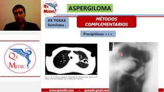 ASPERGILOMA [upl. by Nnahgiel]