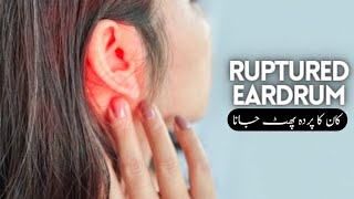 The BEST Treatment of Ruptured Eardrum  Homeopathic Medicine  By Dr Ataullah [upl. by Eriuqs890]